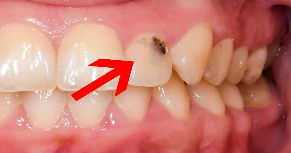 علائم پوسیدگی دندان را بشناسیم