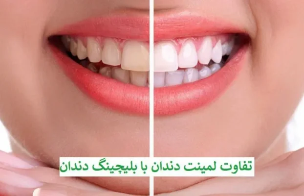 تفاوت بلیچینگ با لمینت دندان چیست؟