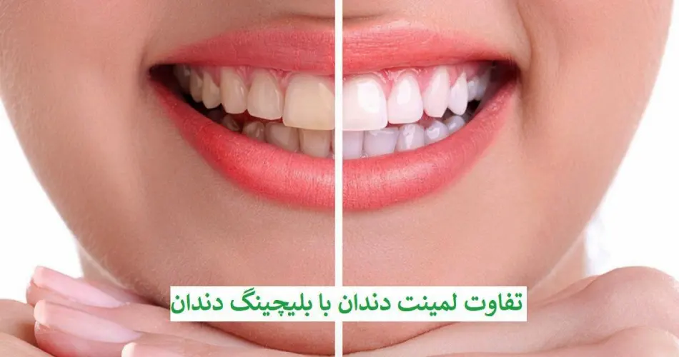 تفاوت بلیچینگ با لمینت دندان چیست؟