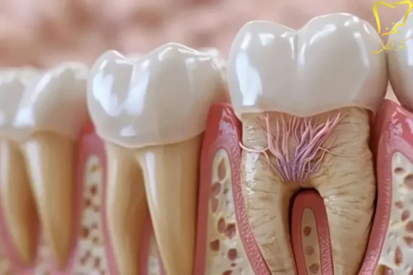 به عصب رسیدن دندان