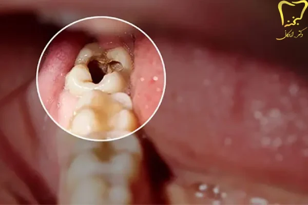 علائم به عصب رسیدن دندان