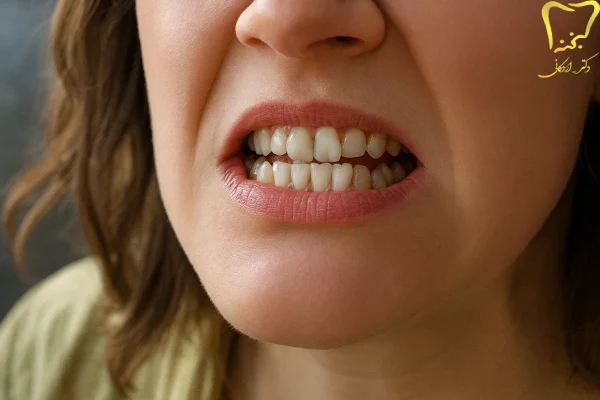 استفاده از لمینت برای دندان‌های کج 
