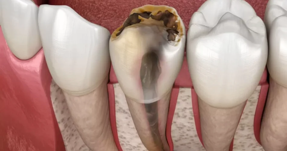 علائم به عصب رسیدن دندان چیست؟