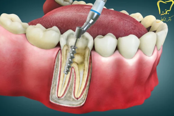 شایع ترین علائم به عصب رسیدن دندان