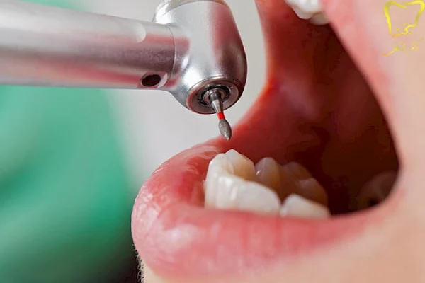 مهمتربن علائم به عصب رسیدن دندان