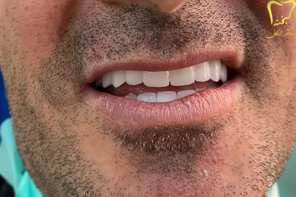 روکش دندان عصب کشی شده