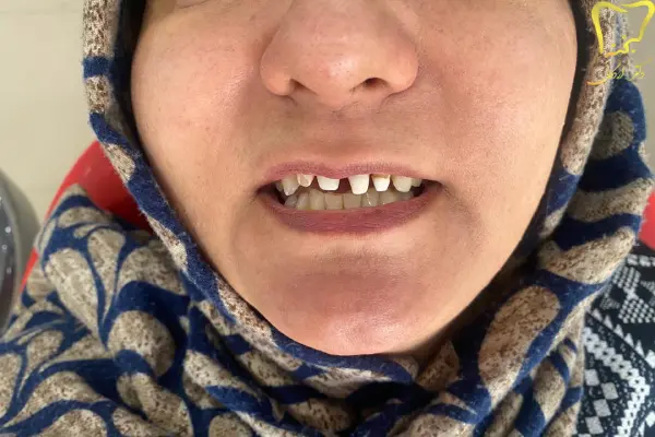 علائم آسیب عصبی دندان جلو