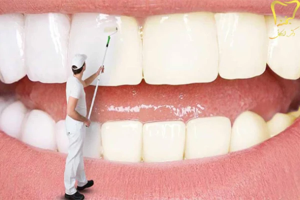 سفید کردن دندان