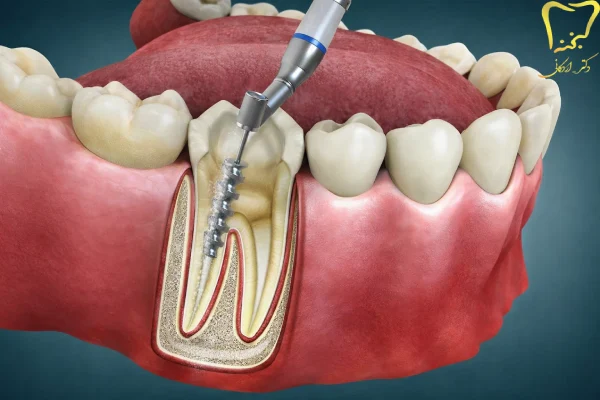 علت عفونت در دندانی که عصب کشی شده است