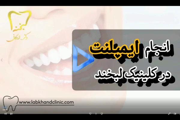 انجام ایمپلنت در کلینیک لبخند