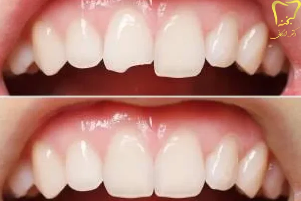 جلوگیری از شکستن دندان
