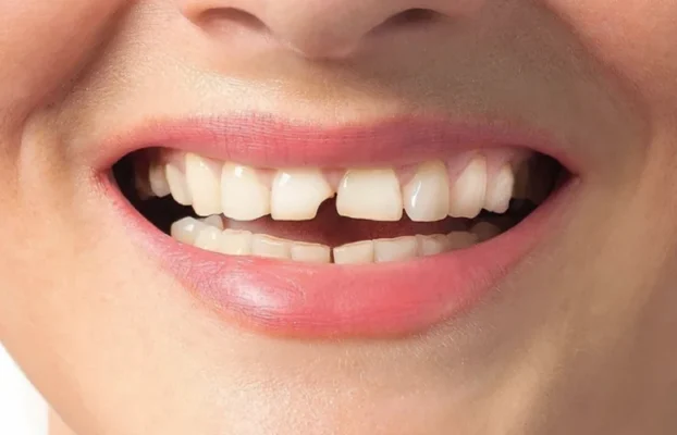 ترمیم دندان شکسته