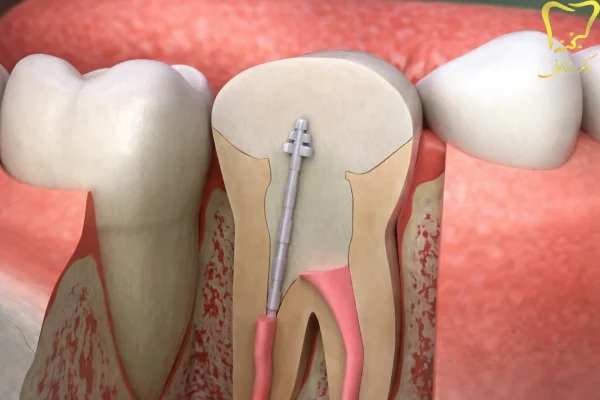 خدمات درمان عفونت ریشه دندان