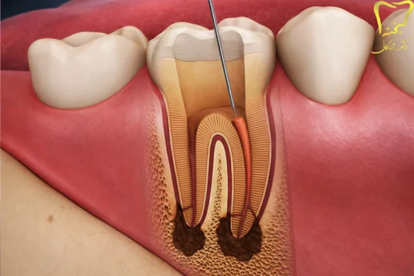 علائم عفونت ریشه دندان