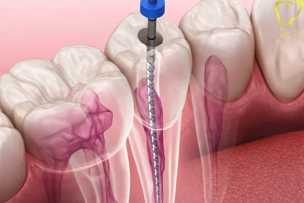 درمان عفونت ریشه دندان
