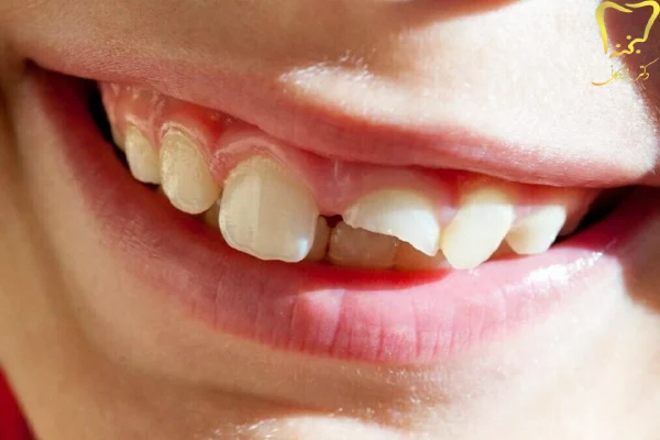 انواع شکستگی دندان
