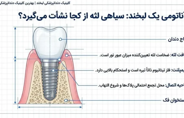 سیاه شدن لثه پس از ایمپلنت دندان؛ علت چیست و آیا جای نگرانی دارد؟