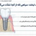 تفاوت سیاه شدن لثه در ایمپلنت‌های فوری و معمولی