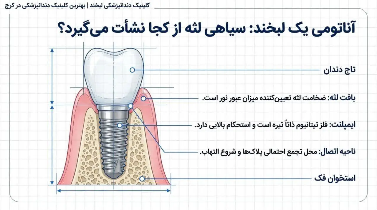 سیاه شدن لثه پس از ایمپلنت دندان؛ علت چیست و آیا جای نگرانی دارد؟