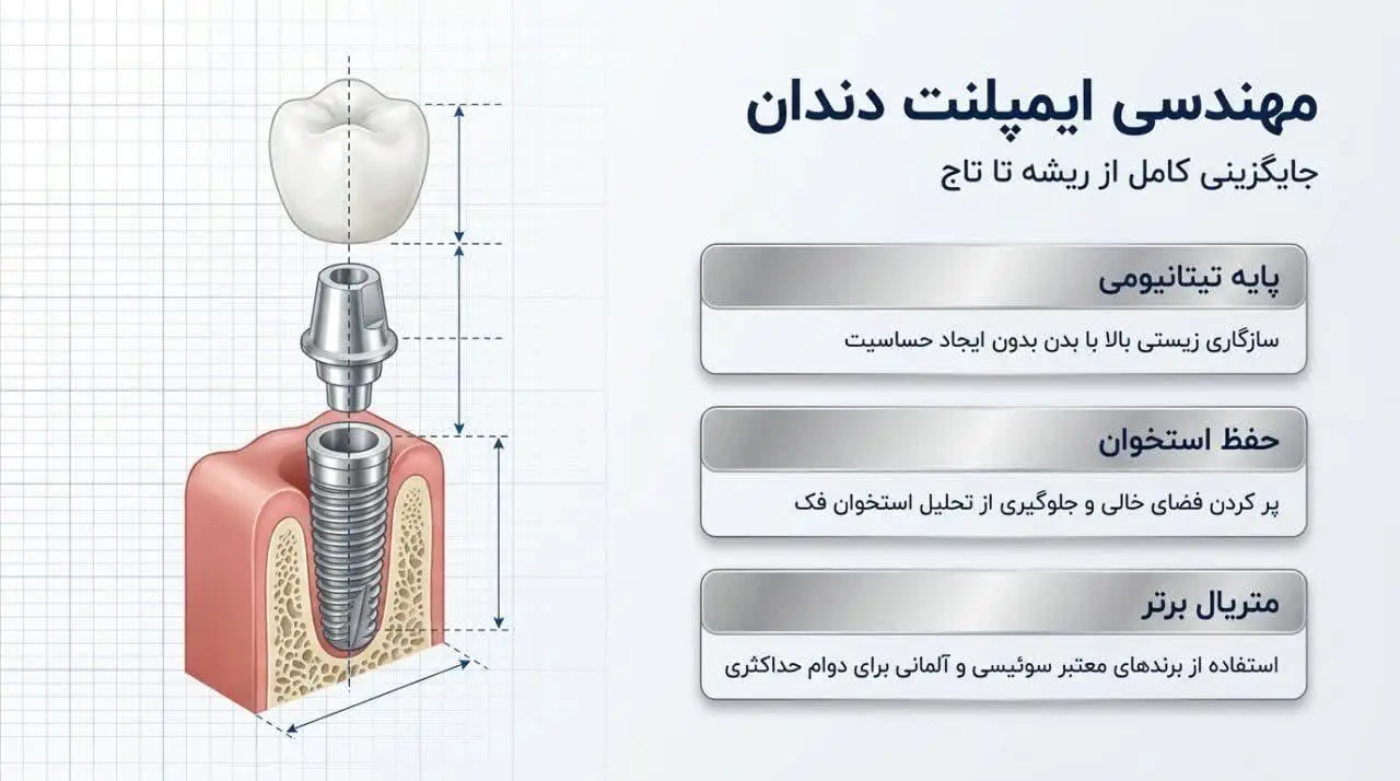 مزیتهای روکش در مقایسه با ایمپلنت