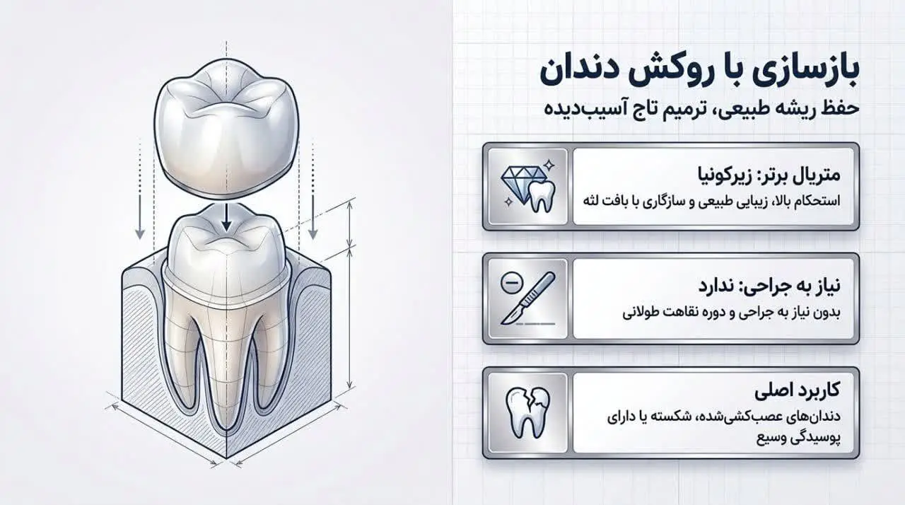 مزیتهای ایمپلنت در مقایسه با روکش