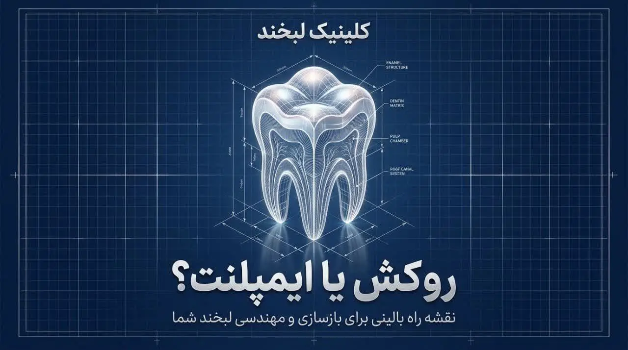 فرق روکش دندان با ایمپلنت؛ کدام انتخاب برای شما مناسب‌تر است؟