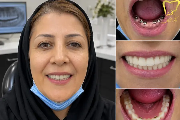قیمت ایمپلنت دندان در کرج